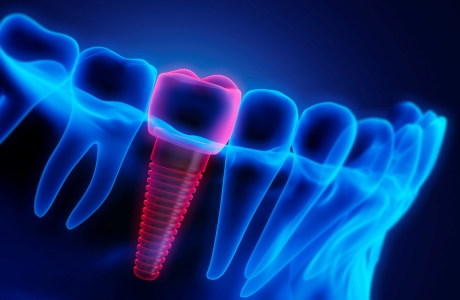 Cirurgia i implants